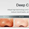 BEAUTYMAXX HYDRA 1 Blackhead Remover Vacuum  Pore Cleaner USB Rechargeable Acne Comedone Extractor Tool Machine with 5 Adjustable Suction Power a