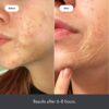 Mighty Patch Surface  Hydrocolloid Large Acne Pimple Patch Spot Treatment 10 count for Body and Larger Breakouts on Cheek Forehead Chin Vegan Cru