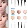 Blackhead Remover Tool Kit 10 Pieces Blackhead Remover Pimple Popping Tool Kit with Black Bag Comedone Extractor Tools for Acne Blackhead Whitehe